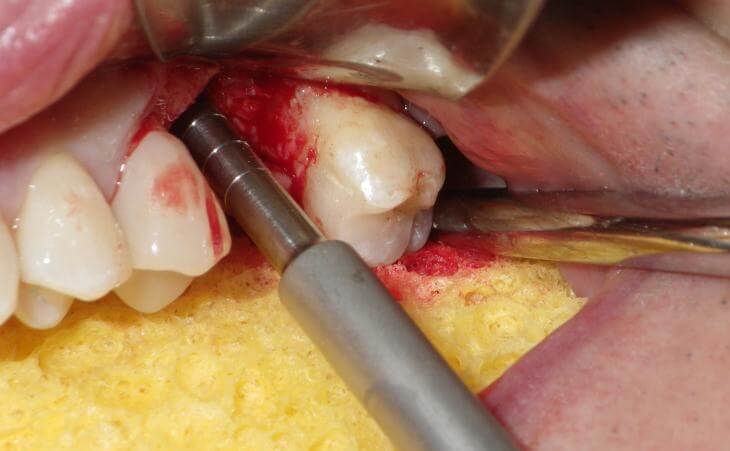 Internal Sinus Lift Procedure