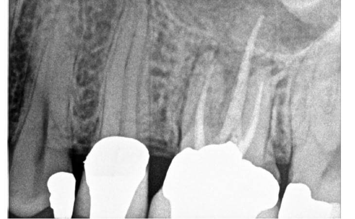 Molar Tooth Treatment