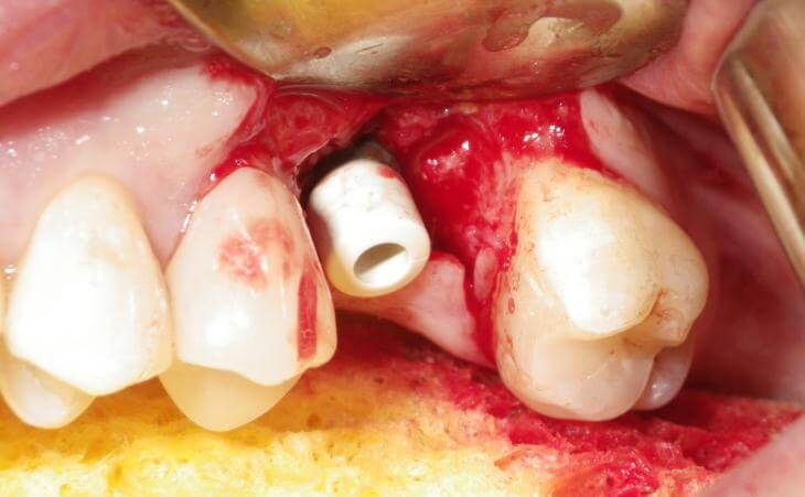 Dental Implant And Connector Placement