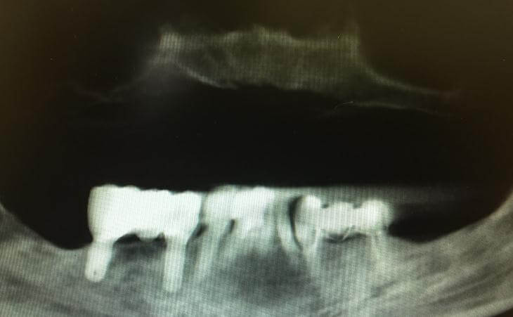 Pre Dental Implant Surgery X-Ray