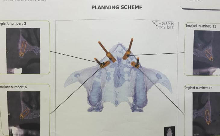 Dental Implant Surgery Planning