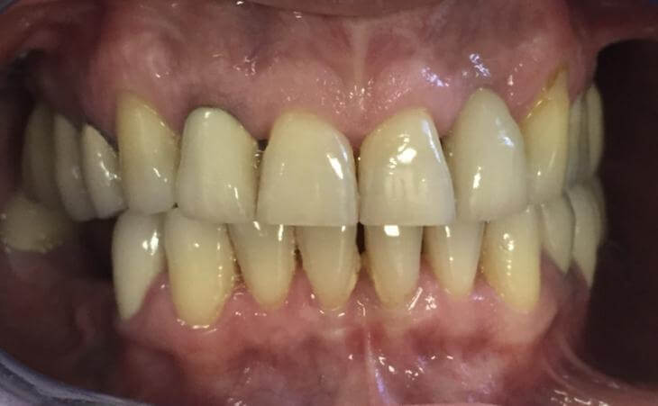 Loose Tooth Treatment