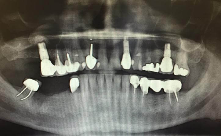 Pre Dental Implant Surgery X-Ray Scan