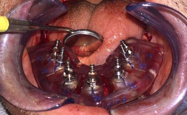 Dental Implant Placement Using Surgical Guide