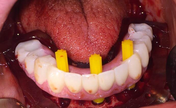 Placement Of Natural-Looking Dental Implant
