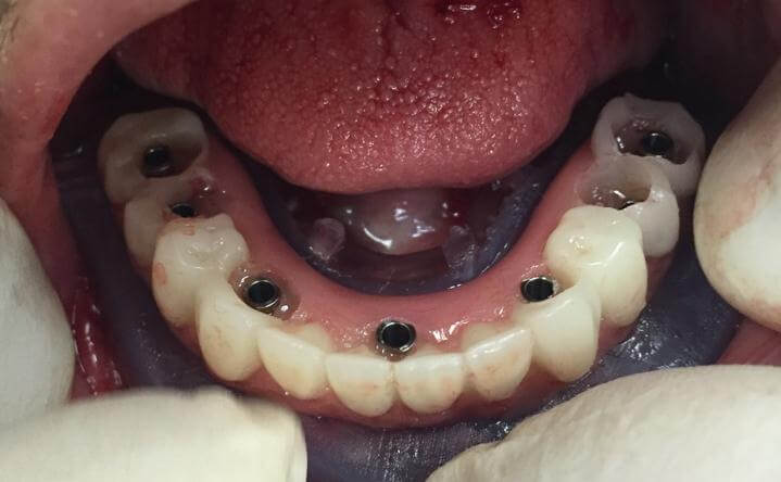 Dental Implant Attachment