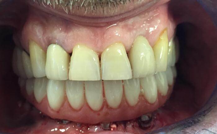 Dental Implant Correctly Placed