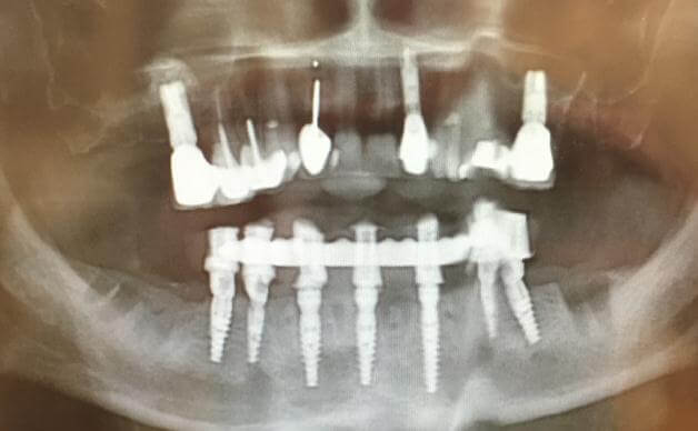 Final Dental Implant X-Ray