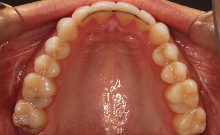 Open Bite Surgery Results Top View