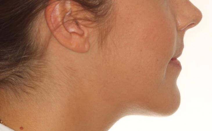 Large Lower Jaw Treatment Results Side View