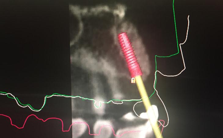 Computer Guided Implant Planning