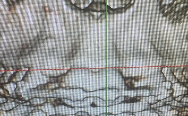 CT Scan of Lacking Bone in Front Jaw