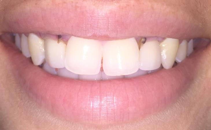 Incisor Teeth Dental Implants