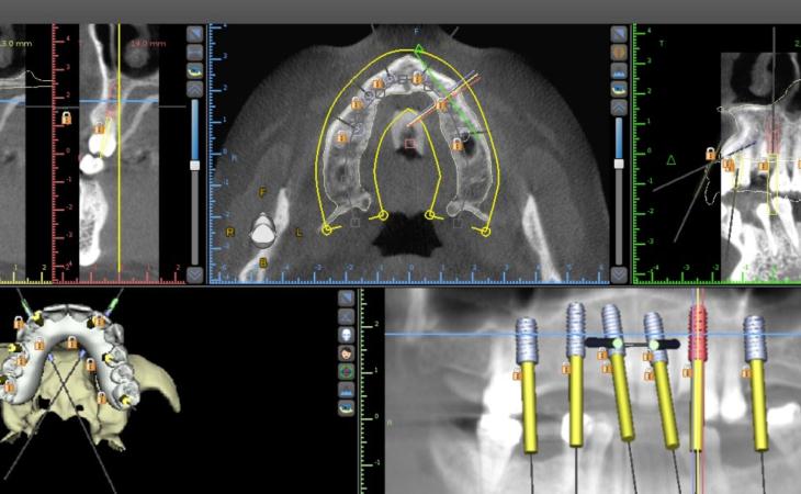 Pre Surgical Planning