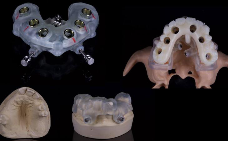 Surgical Guide Mockup to Place Dental Implants