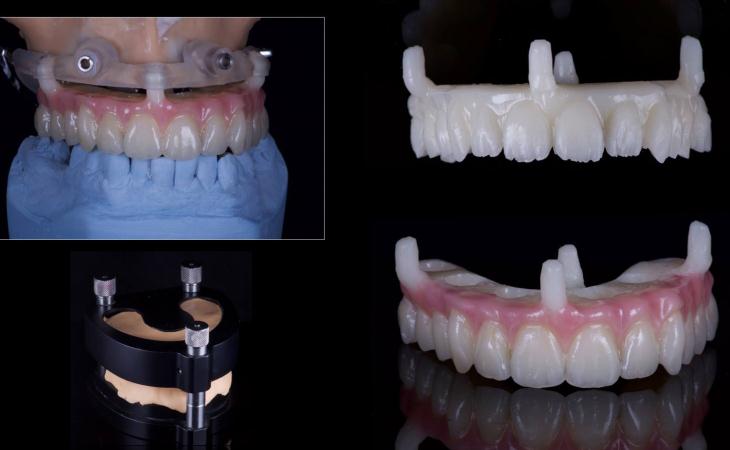 Fabrication of a Computer-Generated Tooth Set Up