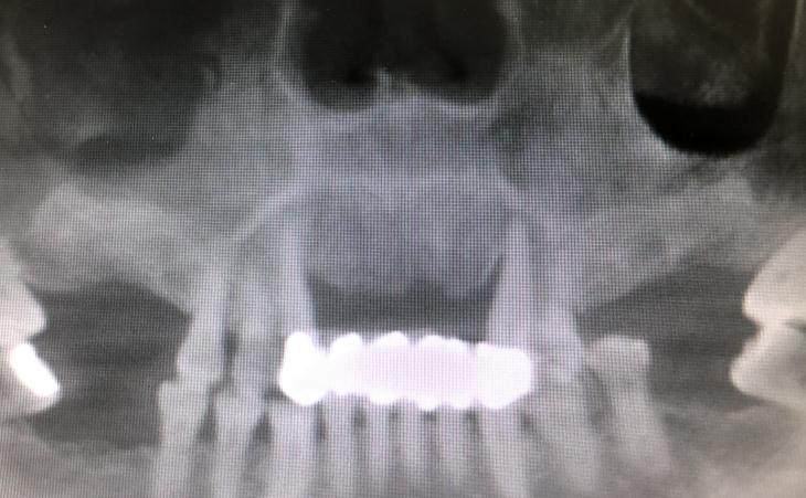 Missing Front Teeth on Patient