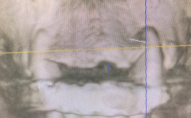 CT Scan Showing Jawbone Loss