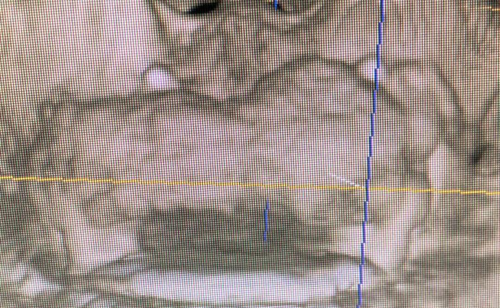 Post Bone Graft CT Scan