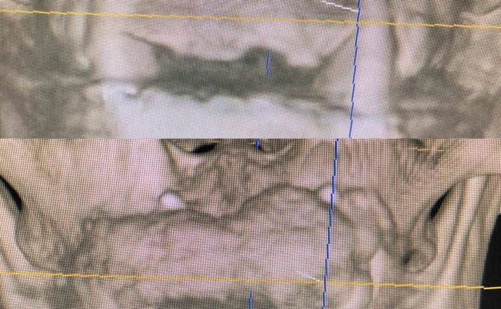 Before and After Jawbone Grafting