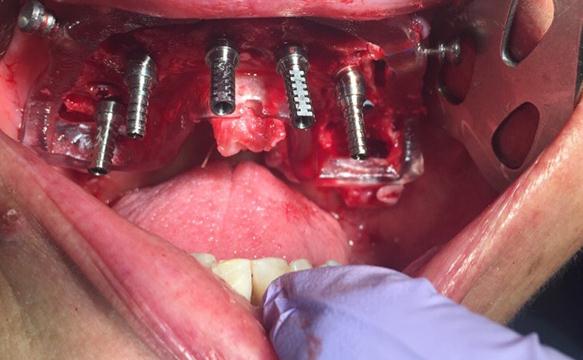 Implants Placed Using Guided Surgery