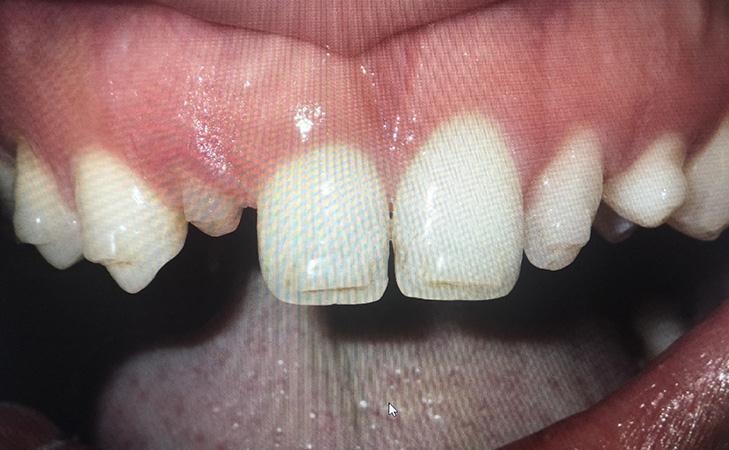 Patient With Missing Lateral Teeth