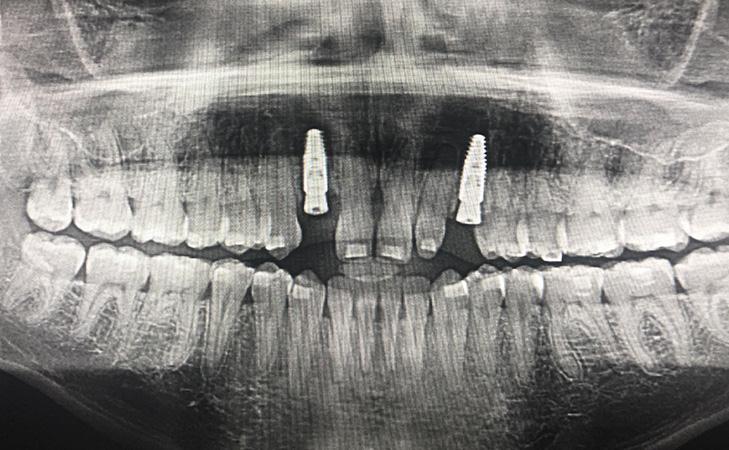 Dental Implants Placed And Baby Teeth Extracted In The Same Surgery