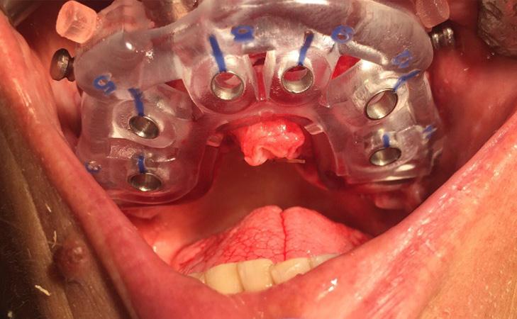 Dental Implant Surgical Guide Used For Ideal Placement