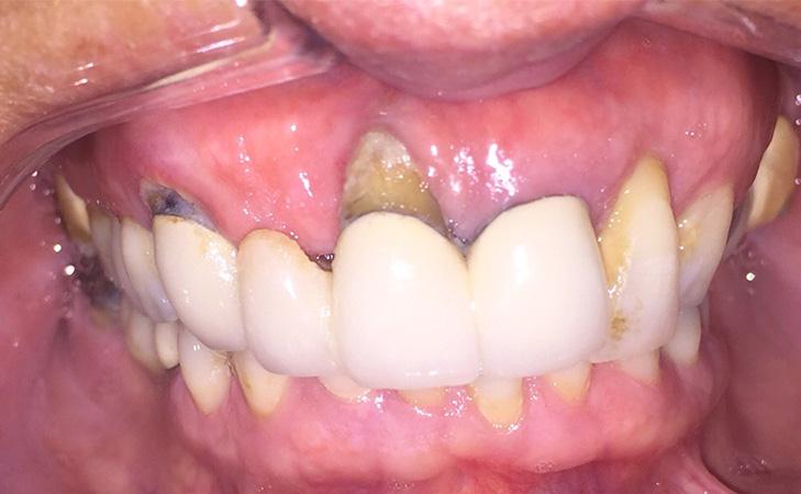Upper Teeth That Are Loose And In A State Of Decay