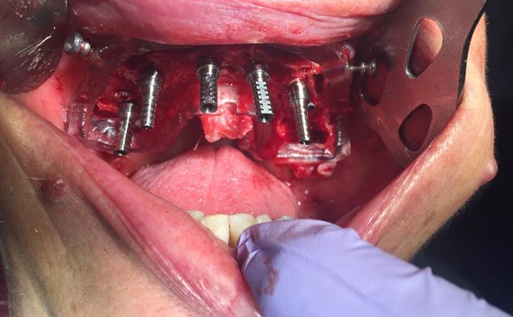 Implants Placed Using Surgical Guide