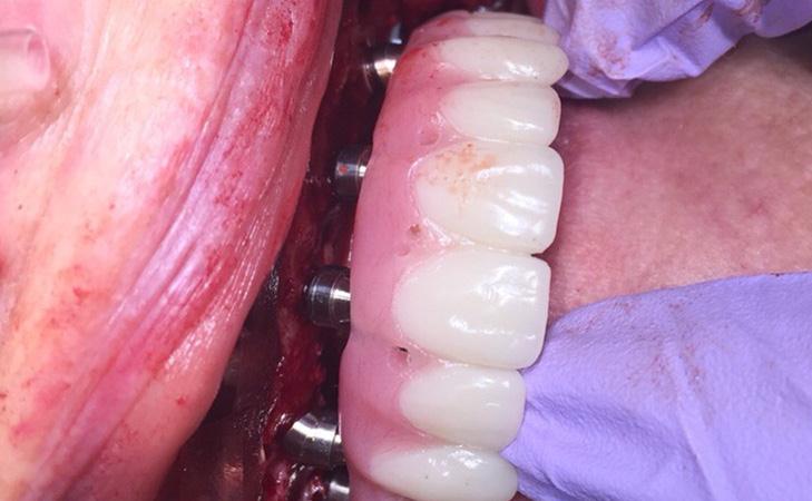 Temporary Bridge Placed On The Implants