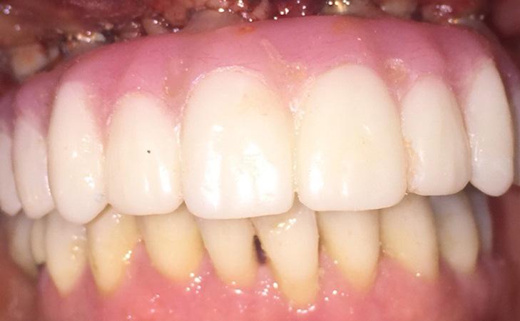 Patient Has Temporary Teeth On The Same Day Of Surgery