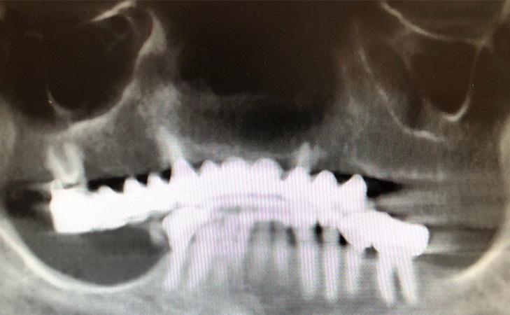 X-Ray Of Teeth Before Surgery