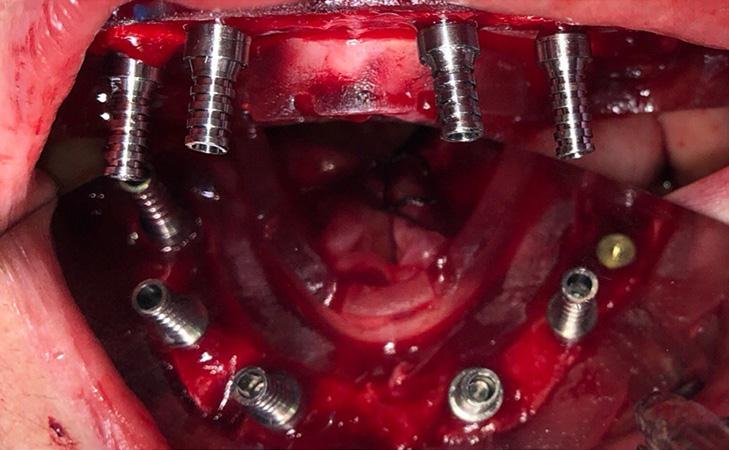 Upper And Lower Jaw Implants