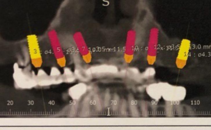 Plan For Upper Jaw Implants