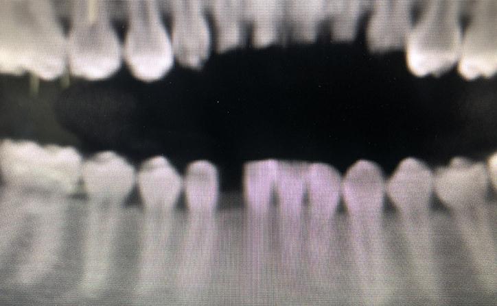 X-Ray Shows Missing Lower Tooth