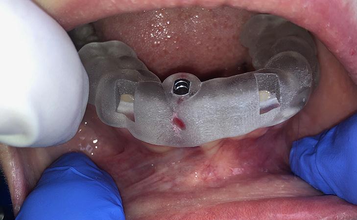 Dental Implant Surgical Guide Used For Ideal Placement
