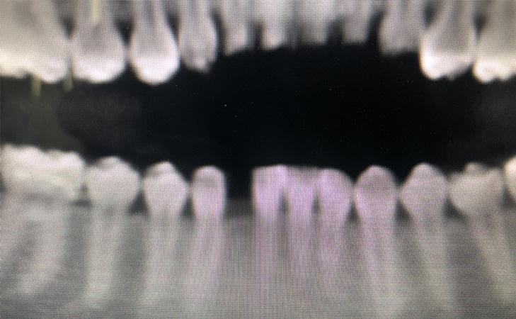 X-Ray Shows Missing Lower Tooth