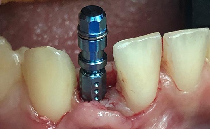 Implant Placed After Using Surgical Guide