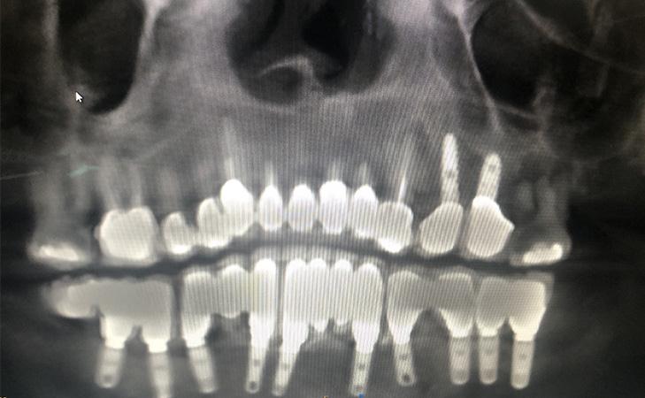 X-Ray Before Surgery Showing Infected Upper Teeth
