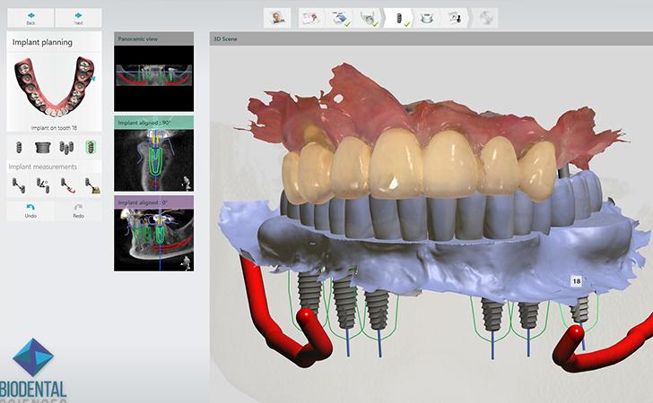 Planning The Look And Position Of Dental Implant Placement