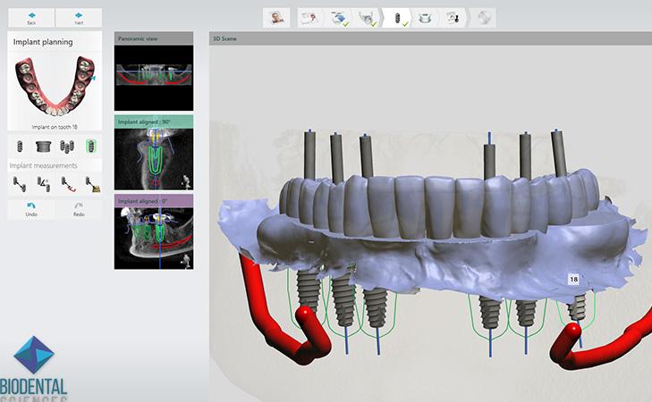 Planning Dental Implant Position