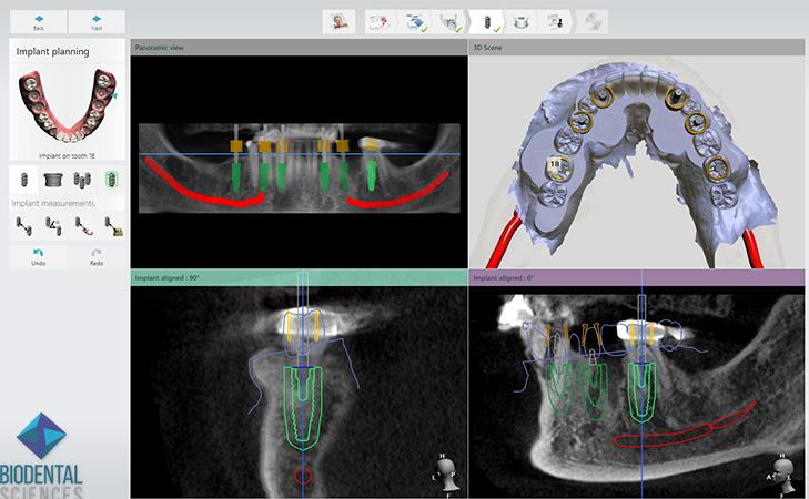 Virtual Planning Of Implant Surgery