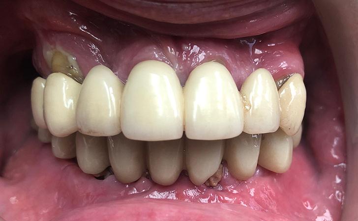 Patient Presented With Worn Lower Teeth And Unhappy With Lower Teeth. Patient Presented With Non-Functional Upper Teeth, Decay And Infection.