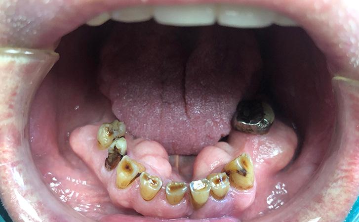 Patient Had Worn Lower Teeth And Extensive Extra Bone In The Lower Jaw Which Made Implant Surgery More Complex