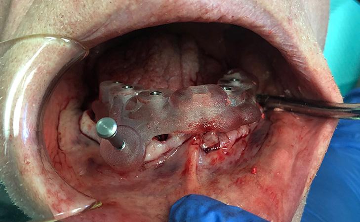 Surgical Implant Guide For Lower Teeth