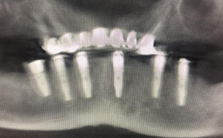 X-Ray After All Lower Teeth Extracted And 6 Dental Implants Placed