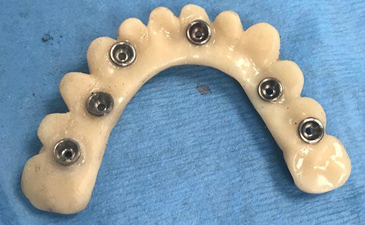 Temporary Lower Teeth Made By The Dentist To Place Same Day As Implant Surgery
