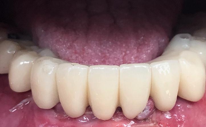 Temporary Lower Teeth Placed Right After Implants Are Placed