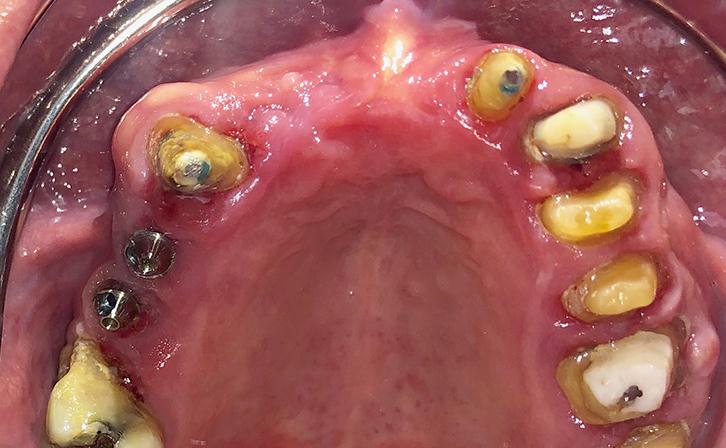 Existing Upper Crown Was Removed By The Dentist